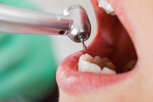 Best Lost Filling or Crown Replacement in Devens, MA